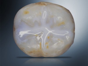 sealants-dental